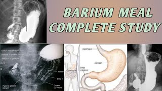 Barium Meal Complete Study Of Stomach