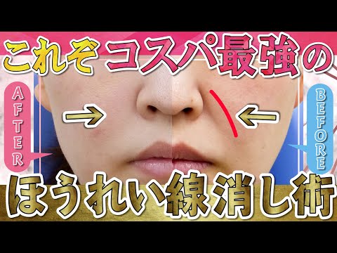 【価格の限界突破】糸リフト＆ヒアルロン酸注入でほうれい線さようなら【施術風景アリ】湘南美容クリニック