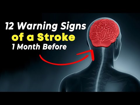 Preventing Strokes: Recognize These 12 Early Warning Signs | 1Stop Health