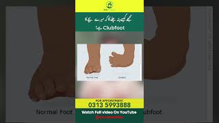 How do we know if our child has clubfoot?