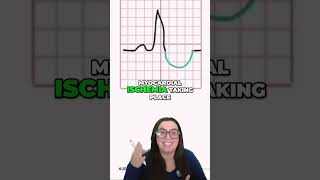 Understanding ST Depression in EKG Causes, Symptoms, and Management