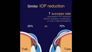 TVT - Tube vs Trab Study