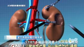 大台中新聞-台中腎臟三顆惡性腫瘤成功切除