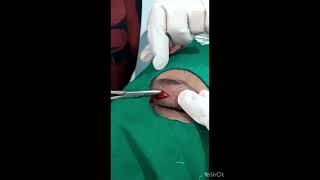 Xanthelasma surgery by Dr. Kirti Jodhani #Drkirti  #xanthelasma #xanthelasmatreatment