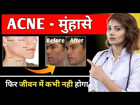 Pimple को कहे अलविदा | 20 दिन में पूरी तरह से ठीक करे | जाने मुंहासे क्यों होते है इसका इलाज क्या है