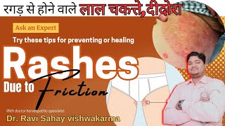 Skin rashes treatment | Skin rashes treatment at home | Home remedies for rashes