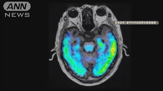 中高年のうつ病　認知症物質が関与か　研究チーム発表【知っておきたい！】【グッド！モーニング】(2025年6月12日)