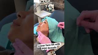 #pdo #pdothreads #threadlifts #pdothreadsLA #threadliftsLA #LAPDOThreads