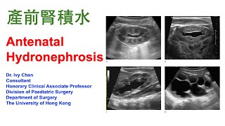 產前腎積水 Antenatal Hydronephrosis by Dr. Ivy Chan (10 Dec 2024)