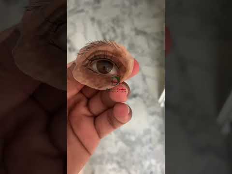 Silicone orbital prosthesis. #artificialeye #anaplastology #blackfungus #orbitalprosthesis