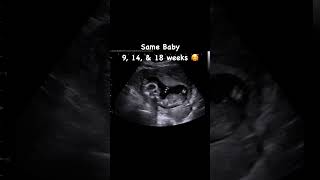 9, 14, & 18 weeks Baby Growth #jerbearimaging #sono #baby #babygrowth