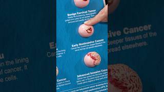Stages of cervical cancer - From benign to advanced | UC Davis Health Tips