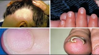 Scalp, Hair and Nails | Hair Fall Problem & Solution | Onycholysis, Alopecia Areata (Nails)