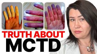 MCTD Treatment EXPLAINED, and #1 Thing You MUST Know!