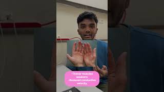 Carpal Tunnel Syndrome - Causes and Features #medical #anatomy #mbbsindia #mbbs #medico #medvlog