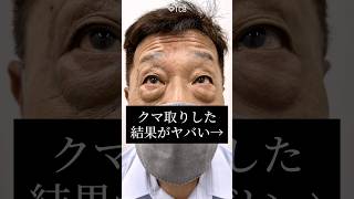 【クマ取り】クマ取りした結果がやばい…#shorts