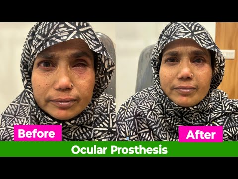 Artificial Eye | Prosthetic Eye | কৃত্রিম চক্ষু সংযোজন। Dr Mantu Akon