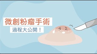 【外科動畫廊】微創粉瘤治療｜表皮囊腫手術｜微創粉瘤切除手術過程