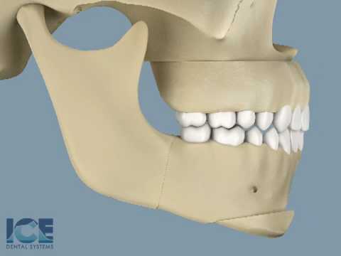 Orthognathic Surgery