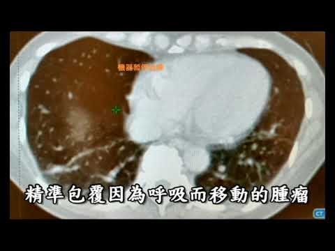 9-3呼吸調控放射治療