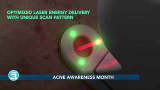 Acne Awareness Month