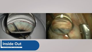 KDB Glide - Surgical Techniques