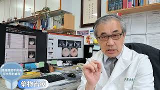 攝護腺癌手術後尿失禁的處理 藥物治療 郭漢崇醫師
