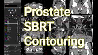 Prostate SBRT Contouring