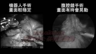 20170130腹腔鏡手術與機器人手術的比較