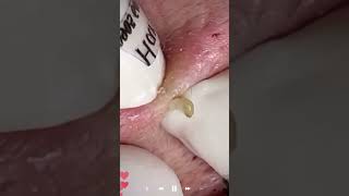 Skincare | Blackheads Removal #518 #tweezers skincare #blackheads blackheads
