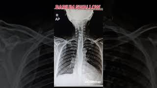 BARIUM SWALLOW #X RAY #RDIOLOGY