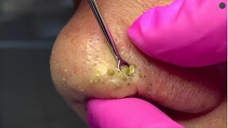 Blackhead Removal: Satisfying  Routine | 120