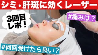 【日本にある韓国美容皮膚科】シミ&肝斑に効くレーザー3回目レポ❤️【オラクル】