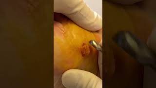 Watch this plantar wart removal surgery - a satisfying procedure for foot enthusiasts!
