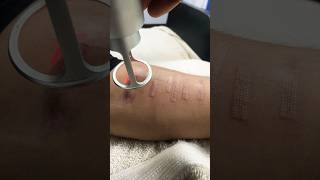 Hand cut mark removal laser treatment.#co2 #scar #viral