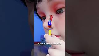 Lego Stuck In Nose For 26 Years 😨