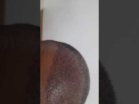 زراعة الشعر في مركز الدكتور ياكتين باير في اسطنبول تركيا