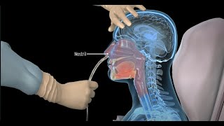 How to insert a nasogastric tube for NG intubation - 3d animation