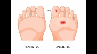 Stages in the development of Diabetes Nephropathy