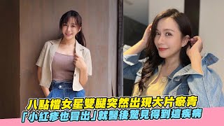 【playin】八點檔女星雙腿突然出現大片瘀青 「小紅疹也冒出」就醫後驚見得到這疾病