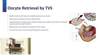 Mastering Egg Retrieval: Innovations in OPU by Dr. Ashwin Rao & Dr. Vijay Pawar