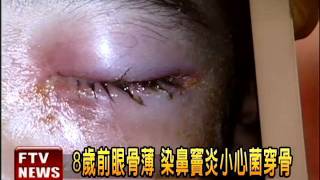 感冒併發鼻竇炎 1歲童眼險瞎－民視新聞