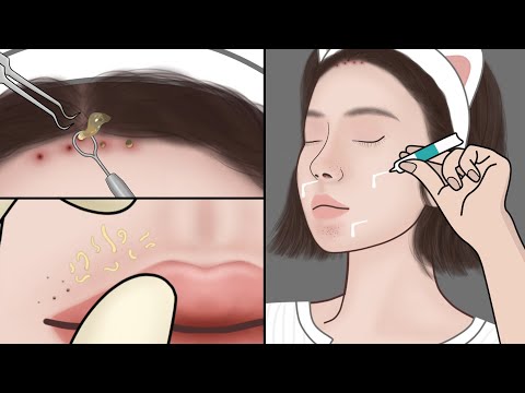 ASMR Blackheads Removal at Home| DIY Blackhead & Whitehead Cleaning Spa | Meng's Stop Motion