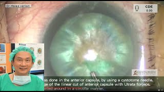 Hypermature Cataract---Symfony Toric IOL 成熟型白內障微創切口超音波手術--- 精準植入長焦段多焦點散光人工水晶體