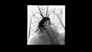 Pulmonary atresia - Ductal stent -  Carotid approach.avi