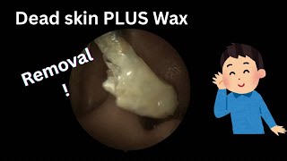 Microsuctioning a Huge Ear Wax Plug - Watch Till The END!