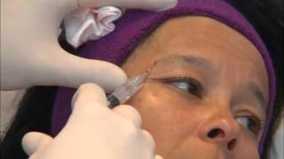 Aplicación VISCODERM 1.6% en Frente. Dr. Giovanni Salti