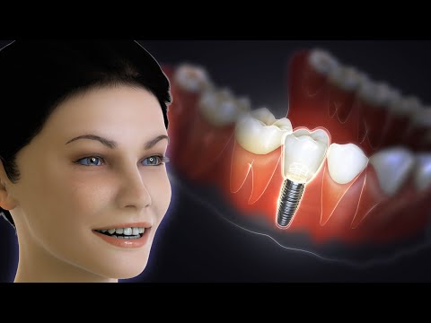 Dental Implant | How is An Amazing Dental Implant Surgery Done | Tooth Placement
