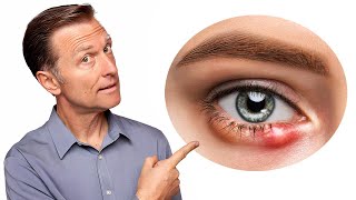 針眼的真正原因，如何快速消針眼？自然療法,柏格醫生 Dr Berg