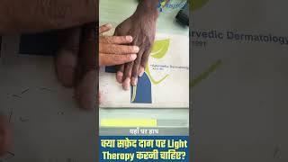 Finger Tip के सफ़ेद दाग का इलाज | Kayakalp Global #shorts #vitiligotreatment #safeddaag